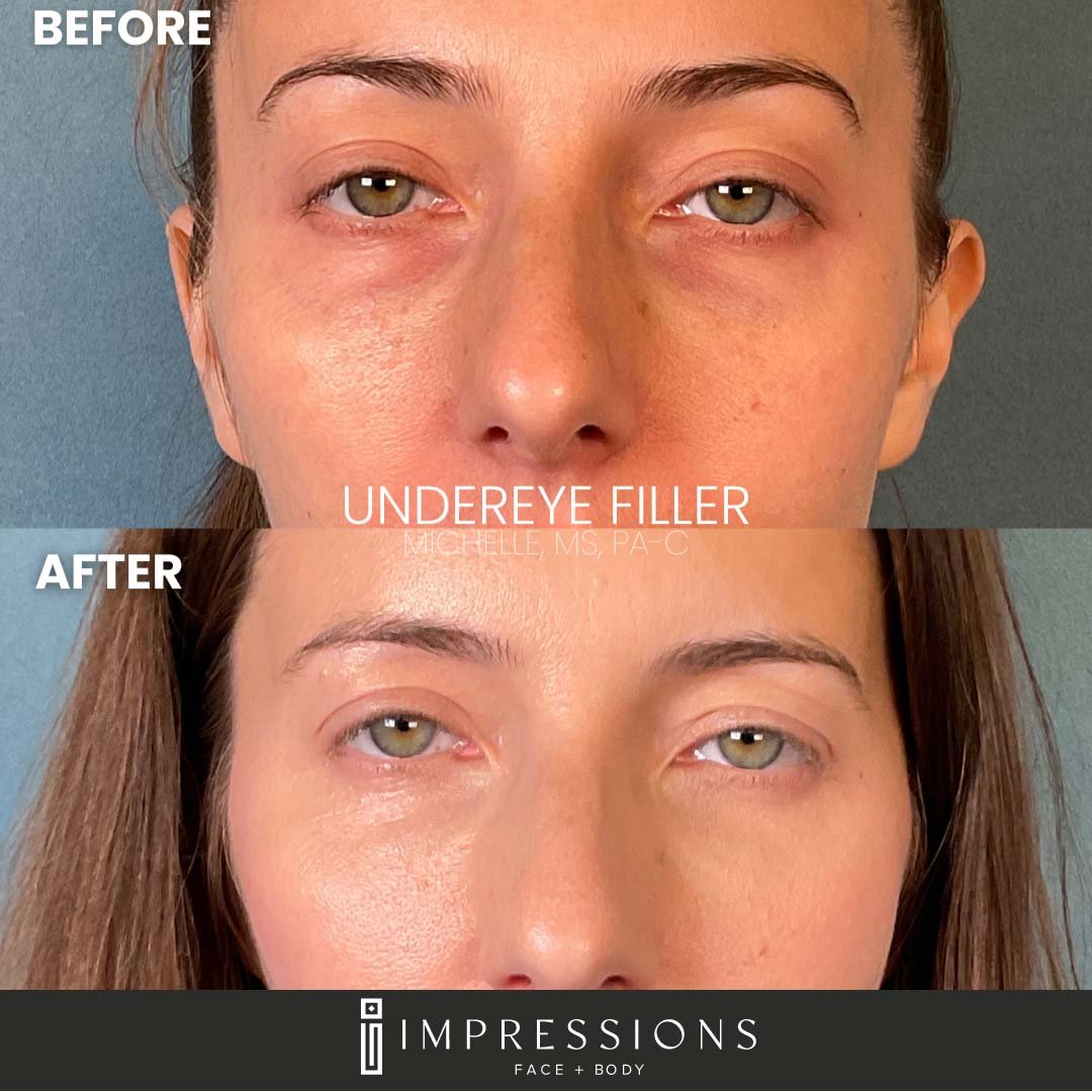 000020855 Undereye Dermafiller 2