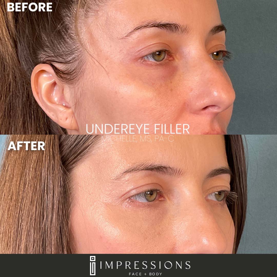 000020855 Undereye dermafiller 1