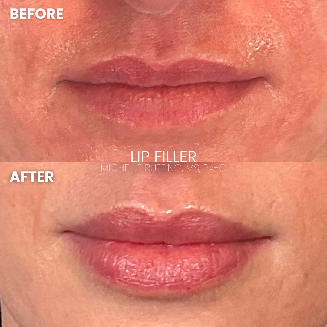 LIP FILLER (2)