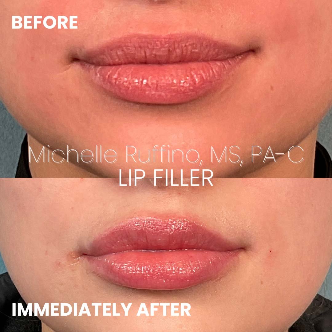 LIP FILLER