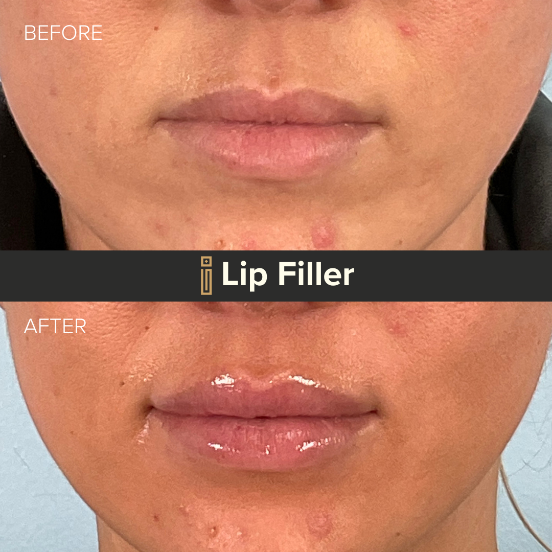 Lip Filler 6