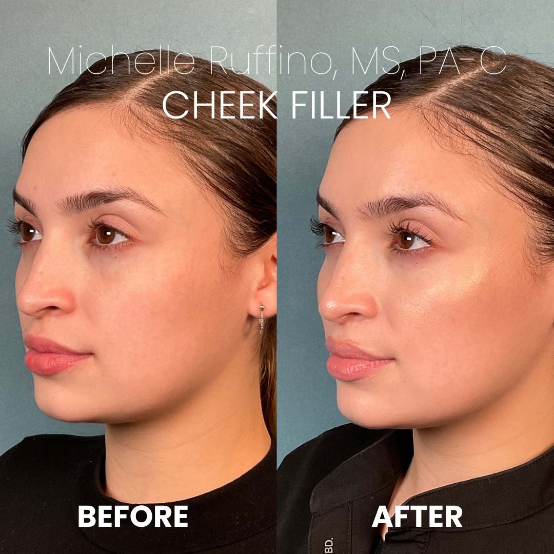 Cheek Filler