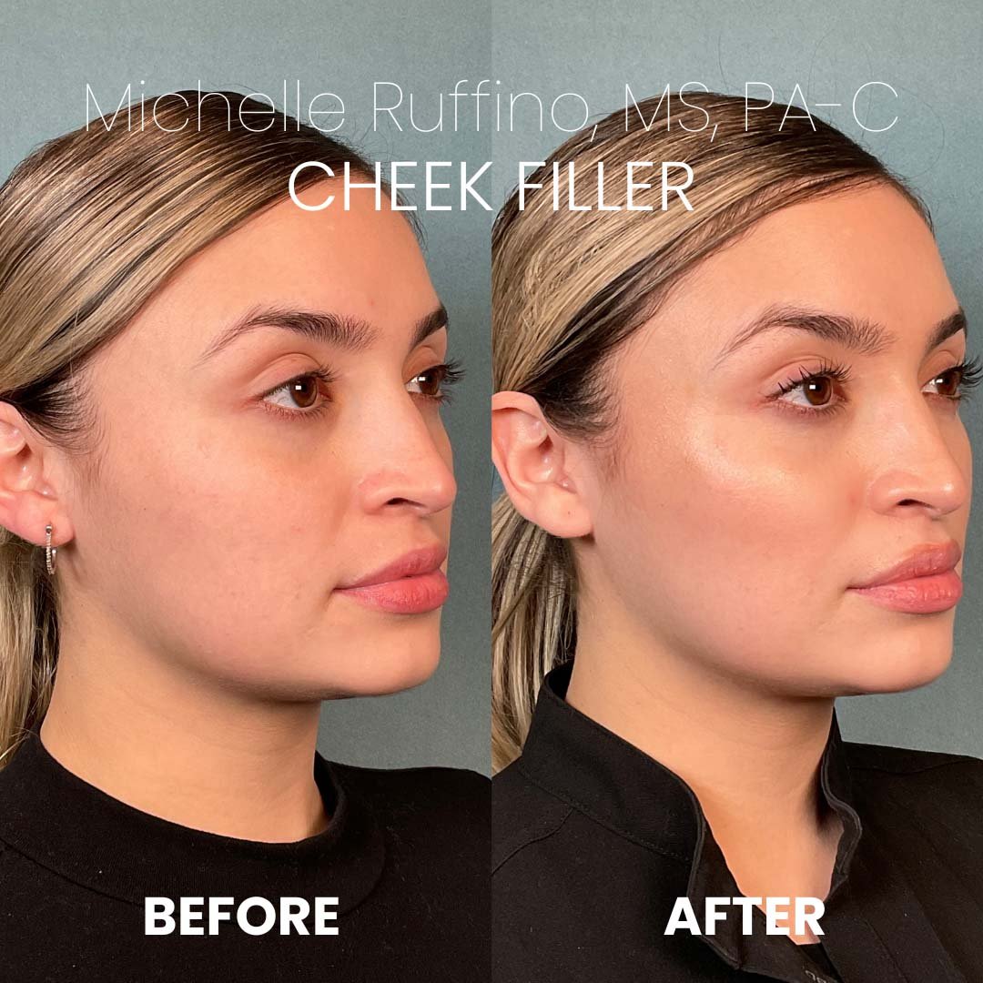 Cheek Filler