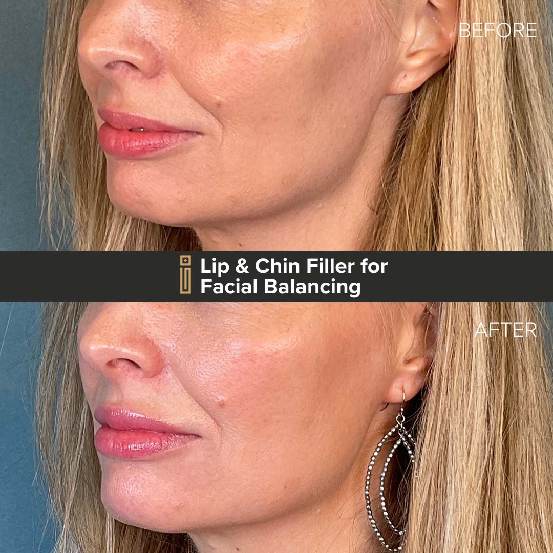 000006665 Lip and Chin Dermal Filler