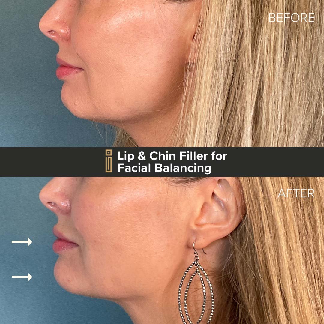 Lip and Chin Dermal Filler