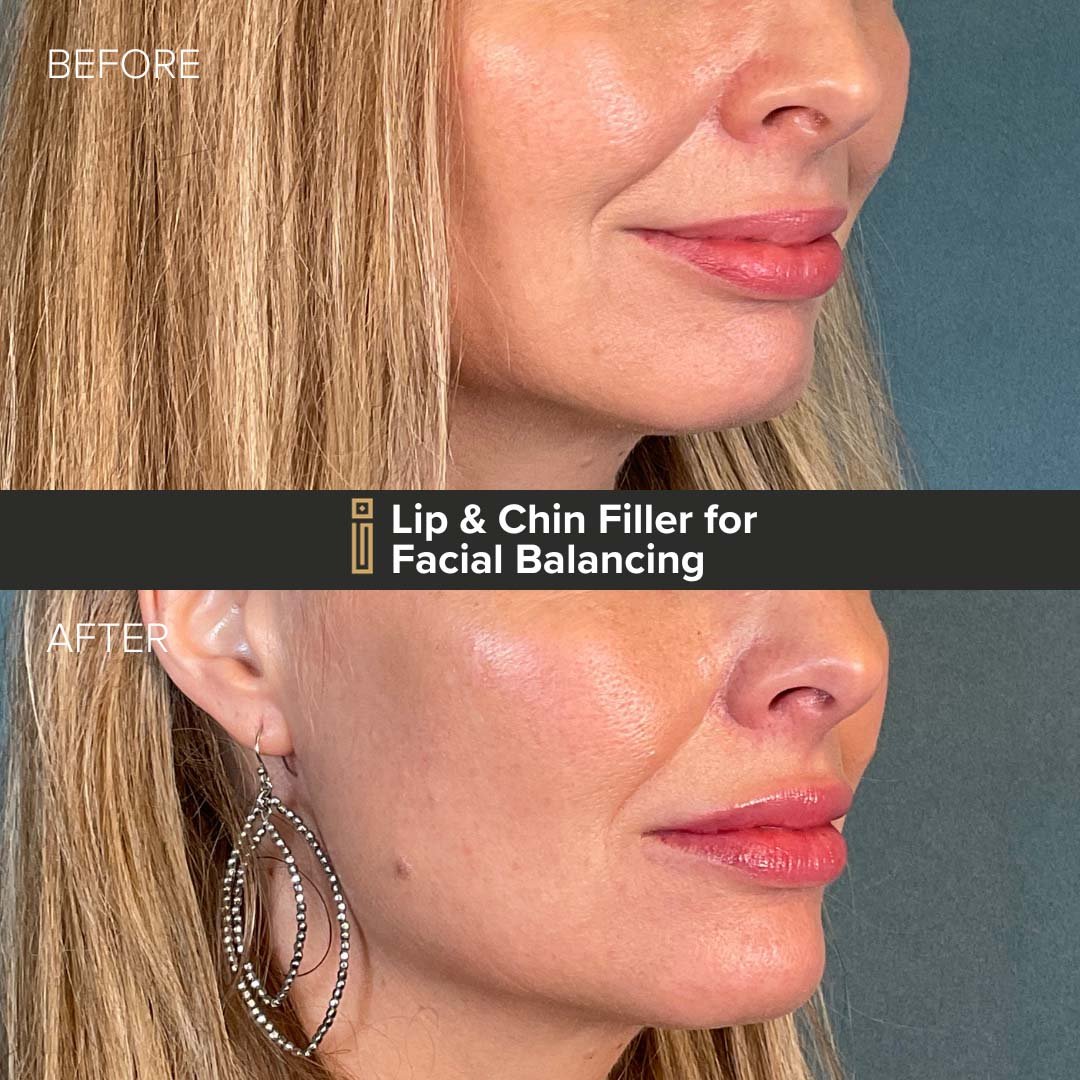 Lip and Chin Dermal Filler