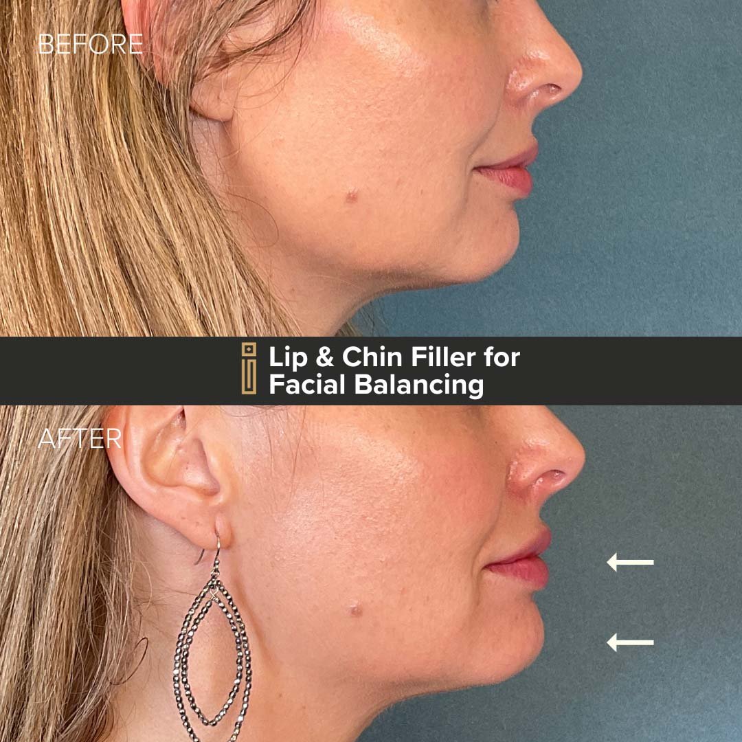 Lip and Chin Dermal Filler