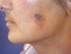 post-inflammatory-hyperpigmentation