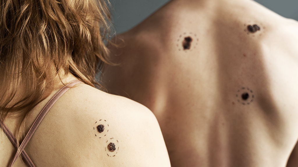 Melanoma vs. Sarcoma: