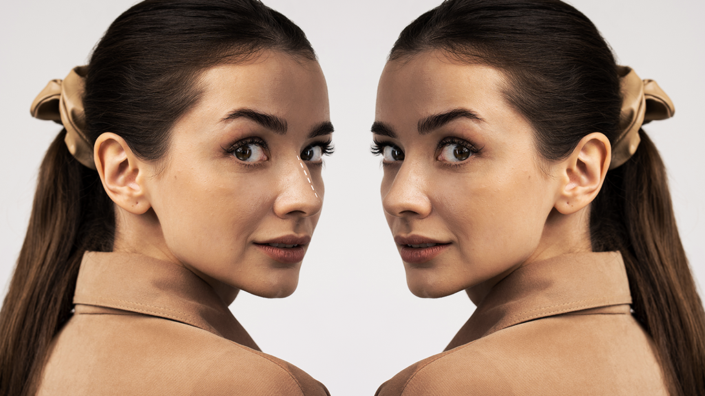 Rhinoplasty Options Cosmetic vs. Functional